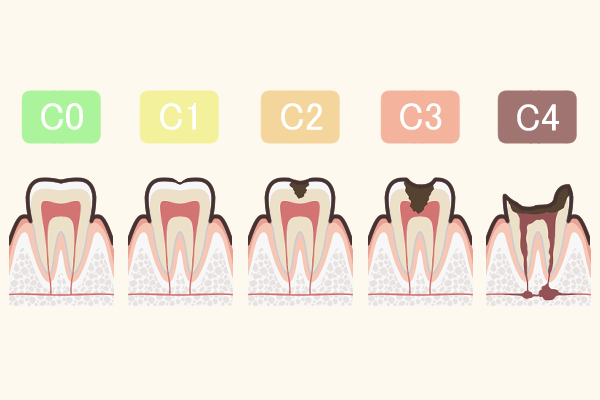 虫歯の過程イラスト