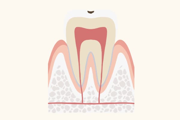 C1の歯の状態