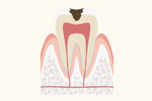 虫歯の歯の様子
