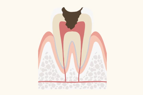 C3の歯の状態