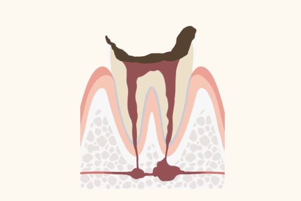 C4の歯の状態