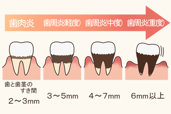 歯周病の進行具合のイラスト